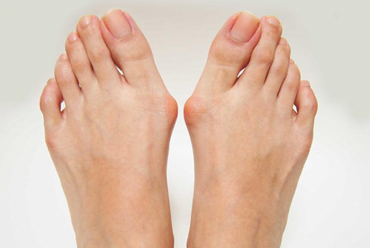 BUNIONS