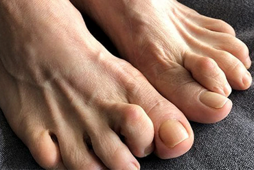 HAMMERTOES