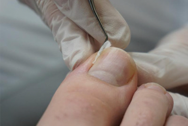 PLANTAR FASCIITIS