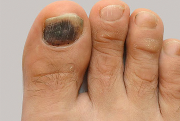 NAIL FUNGUS
